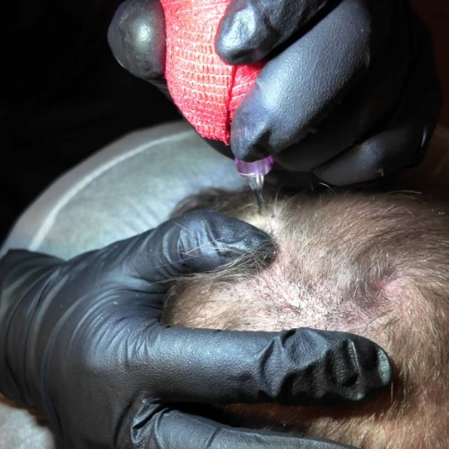 SMP procedure in-progress for hair density.